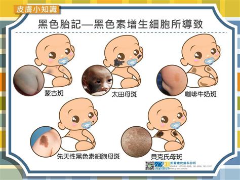 胎記消失|認識胎記的種類與治療照顧